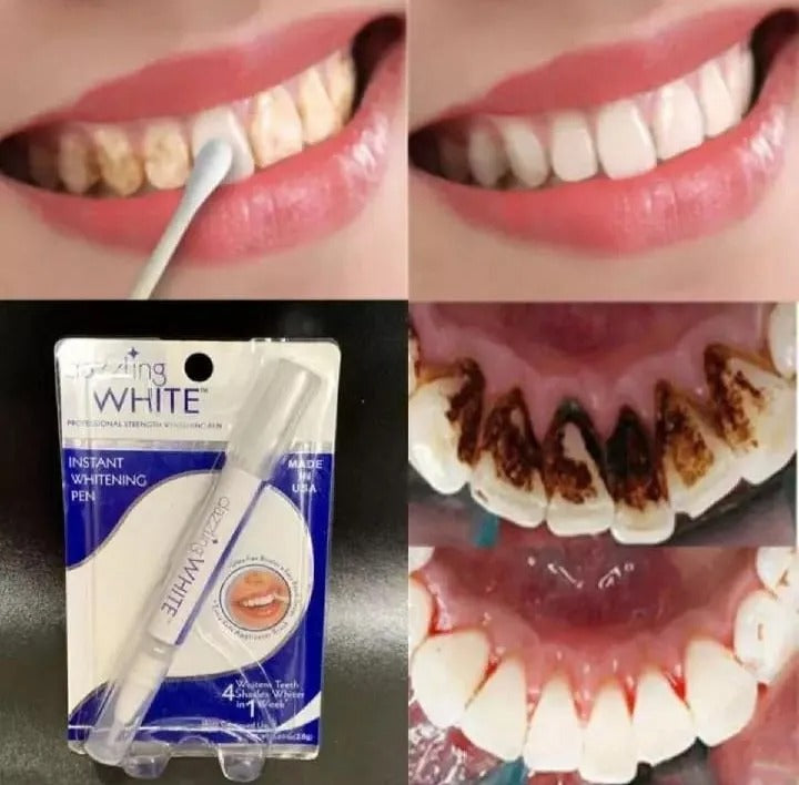 Teeth Whitening Pen | Stain Removing Teeth Whitening